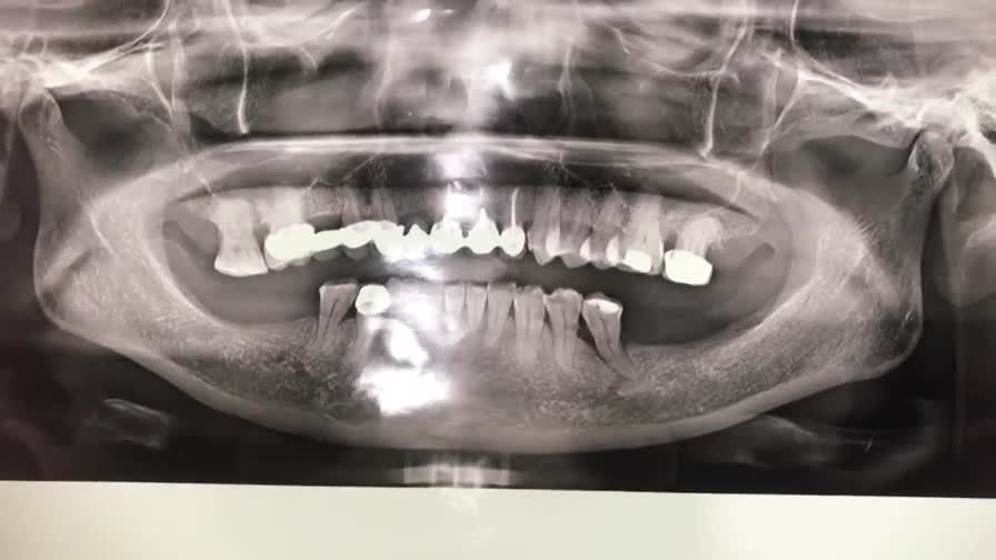 Cấy ghép chân răng nhân tạo implant cho khách hàng mất răng số 35 tại Nha khoa Thùy Anh